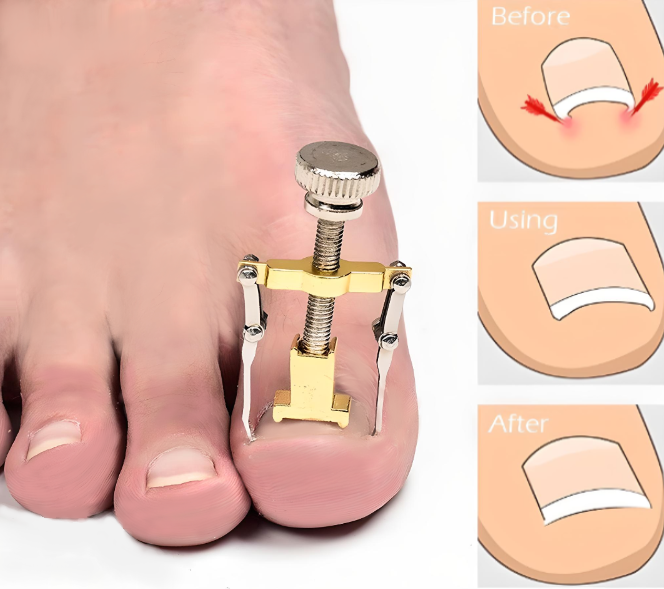 Ingrown Toenail Corrector Clamps – Professional Relief & Nail Reshaping Tool