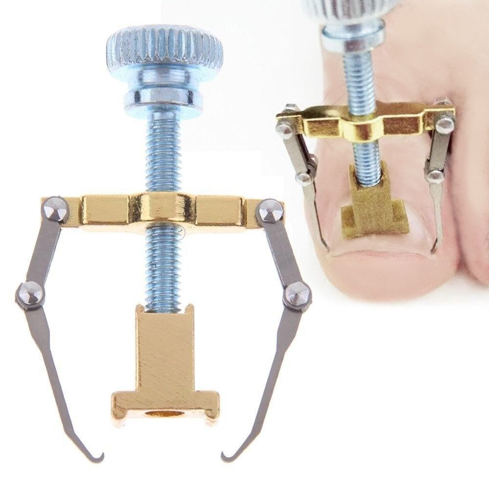 Ingrown Toenail Corrector Clamps – Professional Relief & Nail Reshaping Tool